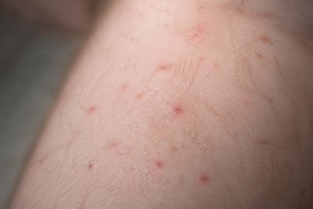 Boutons de puces : comment les reconnaître et s’en débarrasser efficacement